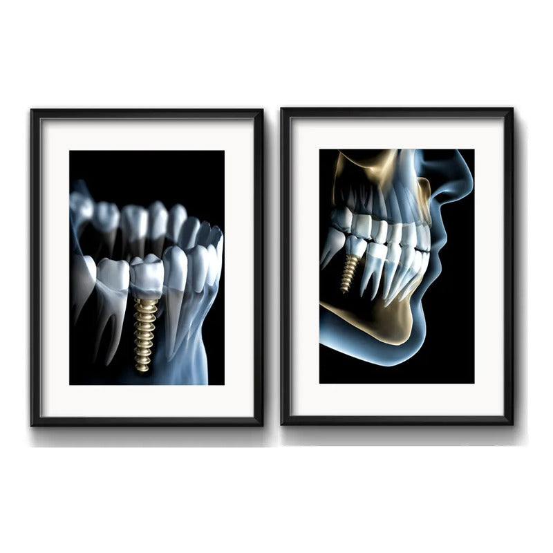 Set 2 Cuadros Implantes Dentales Dentista Clinica Paspartú