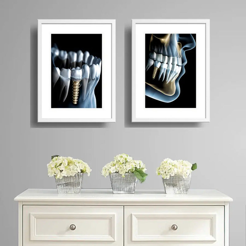 Set 2 Cuadros Implantes Dentales Dentista Clinica Paspartú