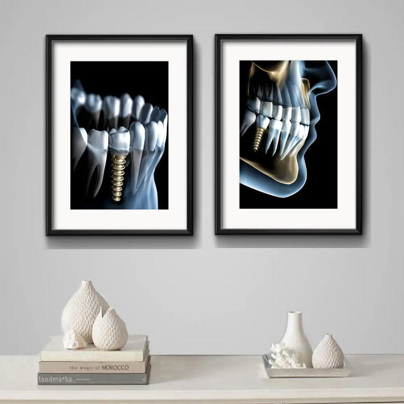 Set 2 Cuadros Implantes Dentales Dentista Clinica Paspartú