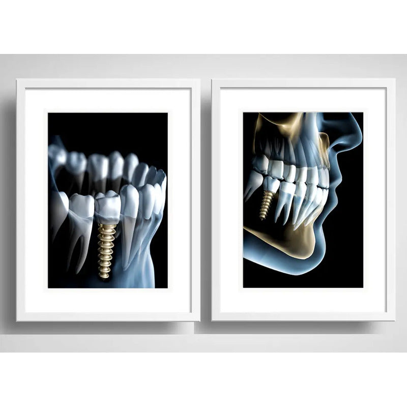 Set 2 Cuadros Implantes Dentales Dentista Clinica Paspartú