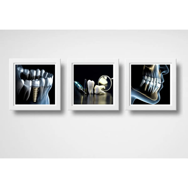 Set 3 Cuadros Implantes Dentales Dentista Clinica Estética