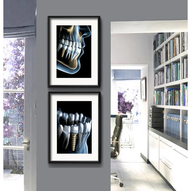 Set 2 Cuadros Implantes Dentales Dentista Clinica Paspartú